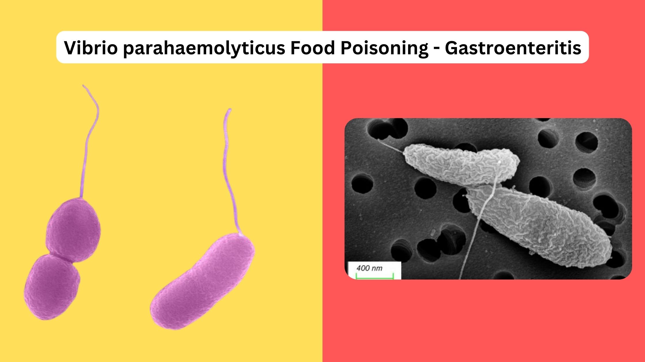 Vibrio parahaemolyticus Food Poisoning - Gastroenteritis