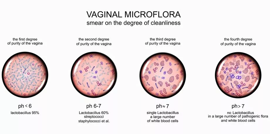 Healthy and infected vaginal flora
