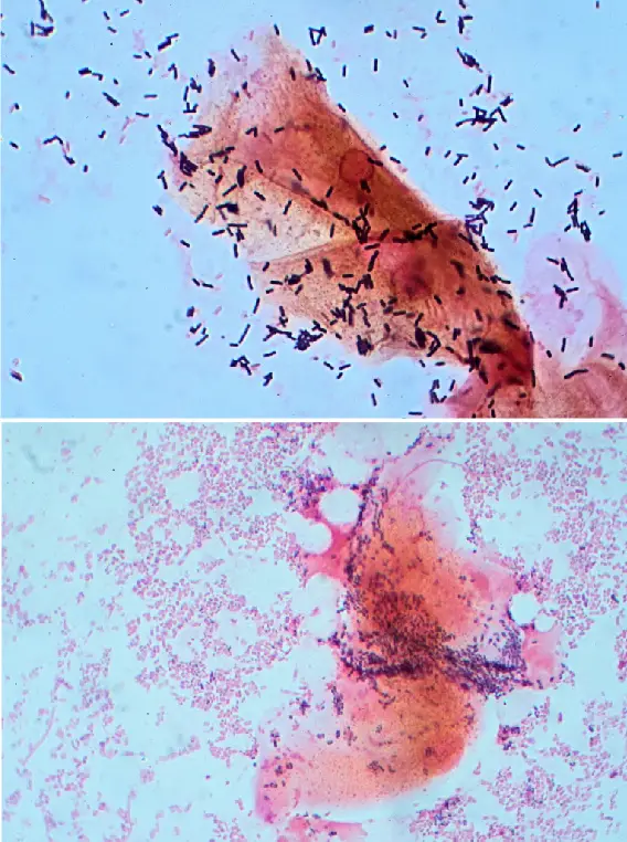 Gram stain of cells from the vagina (the same magnification) with normal bacterial flora (top) and the bacteria that cause vaginosis (bottom).
